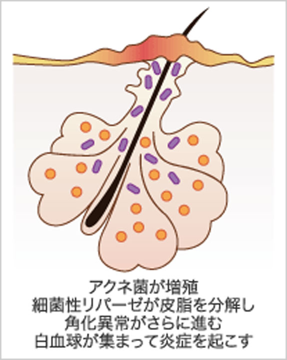 （図1）炎症とにきび発症