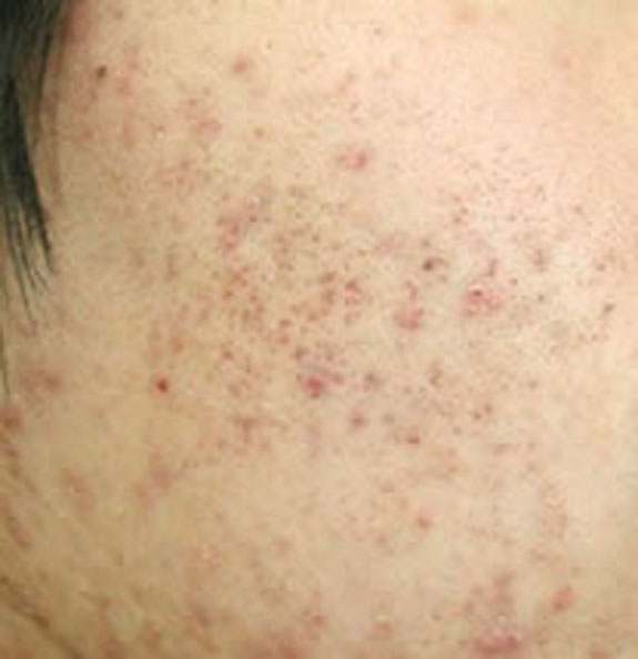 コメドタイプ 船橋市 にきび治療 千葉 埼玉にきび治療室