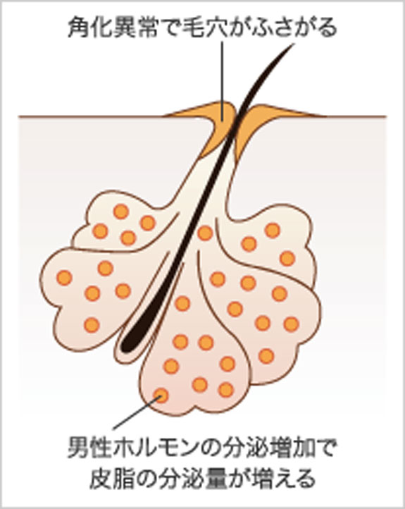 （図2）皮脂の分泌量が多くなり毛穴が閉塞するとにきびができる