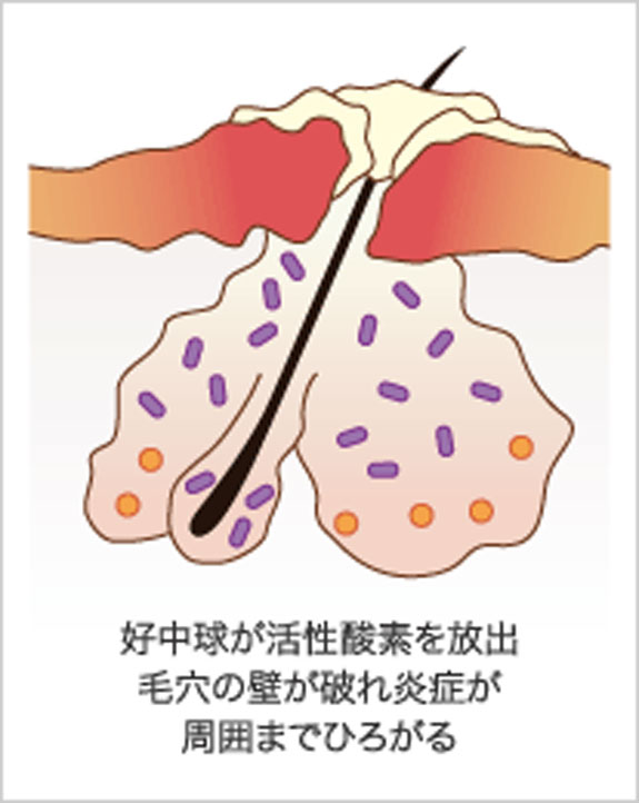 （図2）炎症の進行